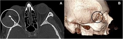 Lateral orbital wall reconstruction after basal cell carcinoma penetration—Case report